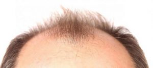 Steroids cause accelerated hair loss from the temples and scalp